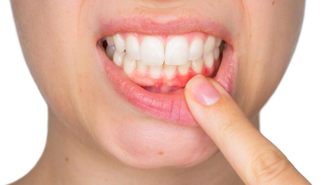 How to Cure Gum Disease without a Dentist - what is the fastest way to get rid of a gum infection